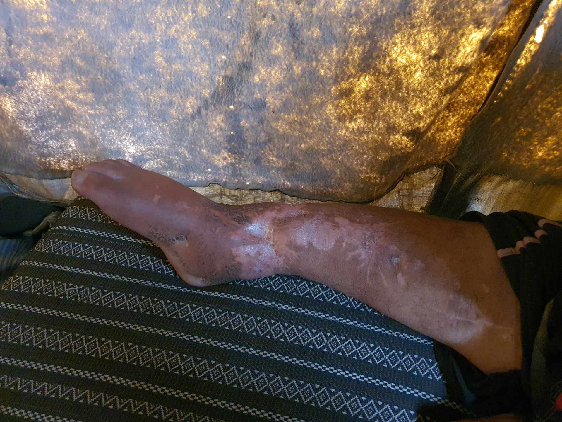 A war injury caused Mustafa disability