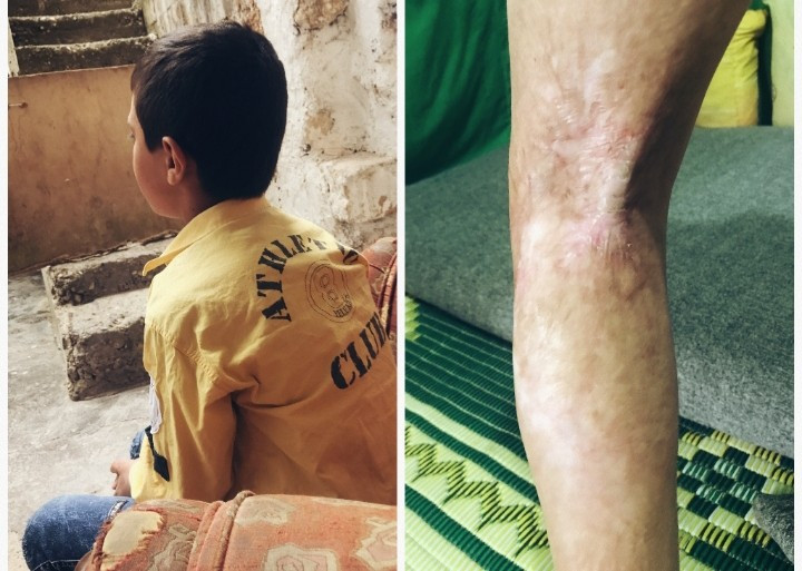 طفل تعرض لحرق في قدمه!