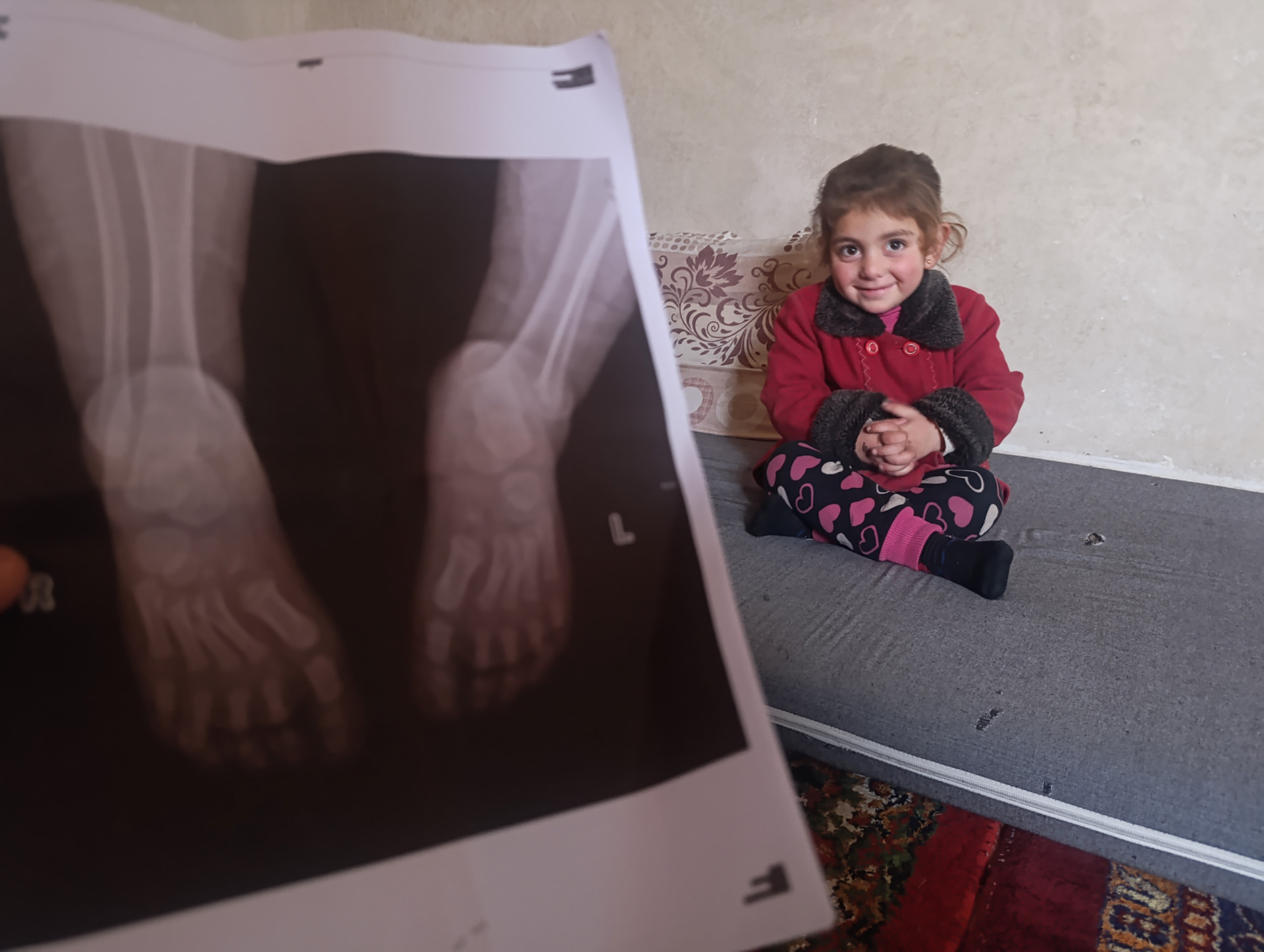 طفولة تتألم في كل خطوة