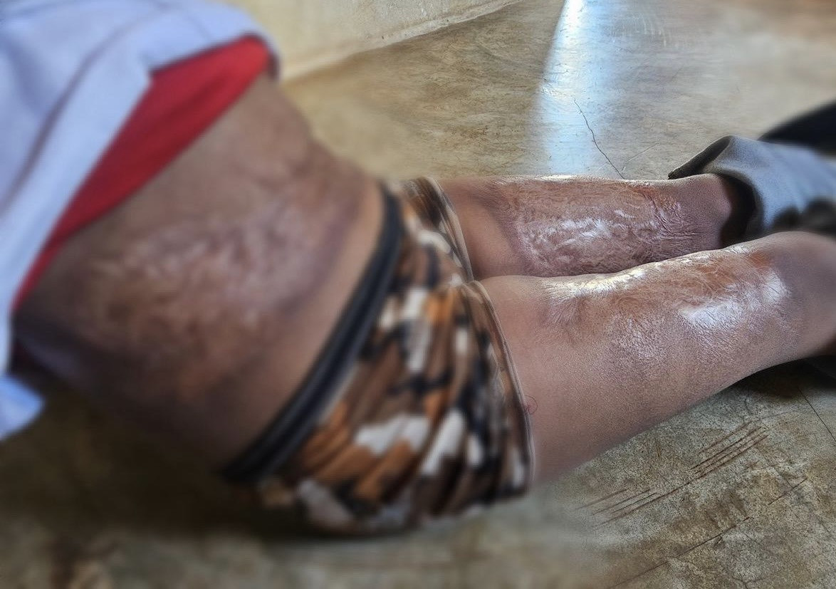 النار التهمت الخيمة وجسد غزل