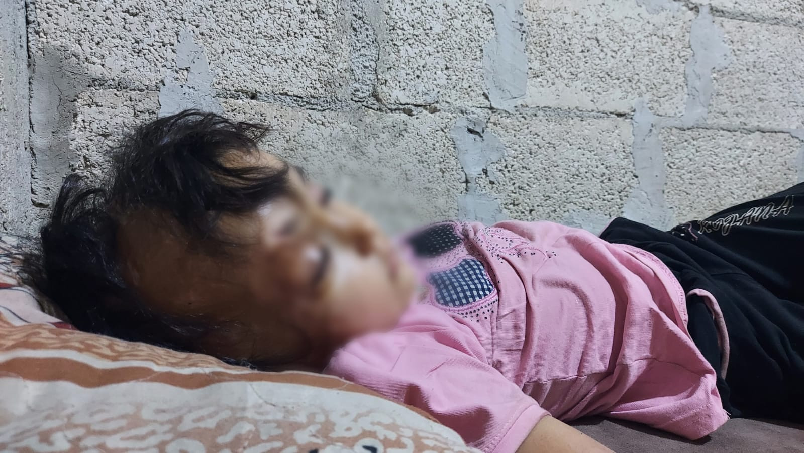 Sham got burned a year ago and is still suffering until now