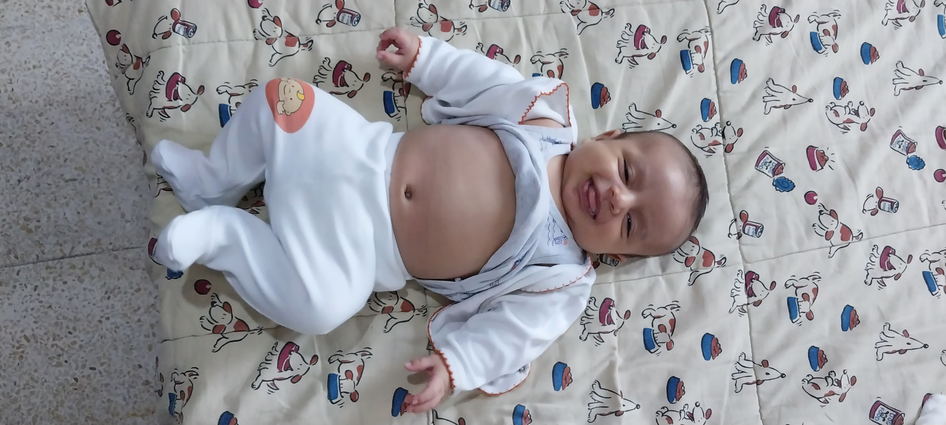 A child suffering from kidney swelling and in need of an urgent surgery