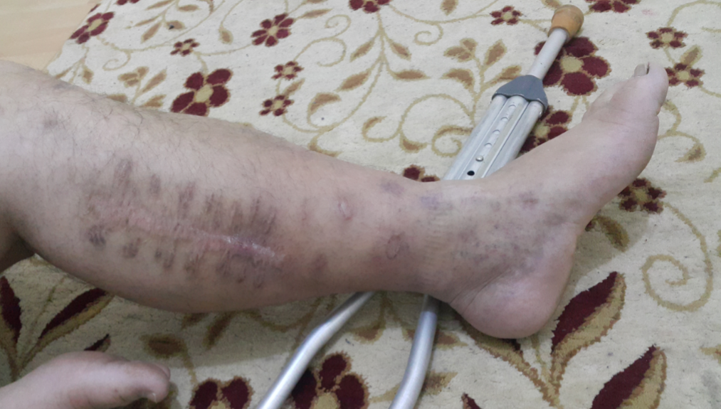 A young man survivor from Eastern Ghouta siege needs help!