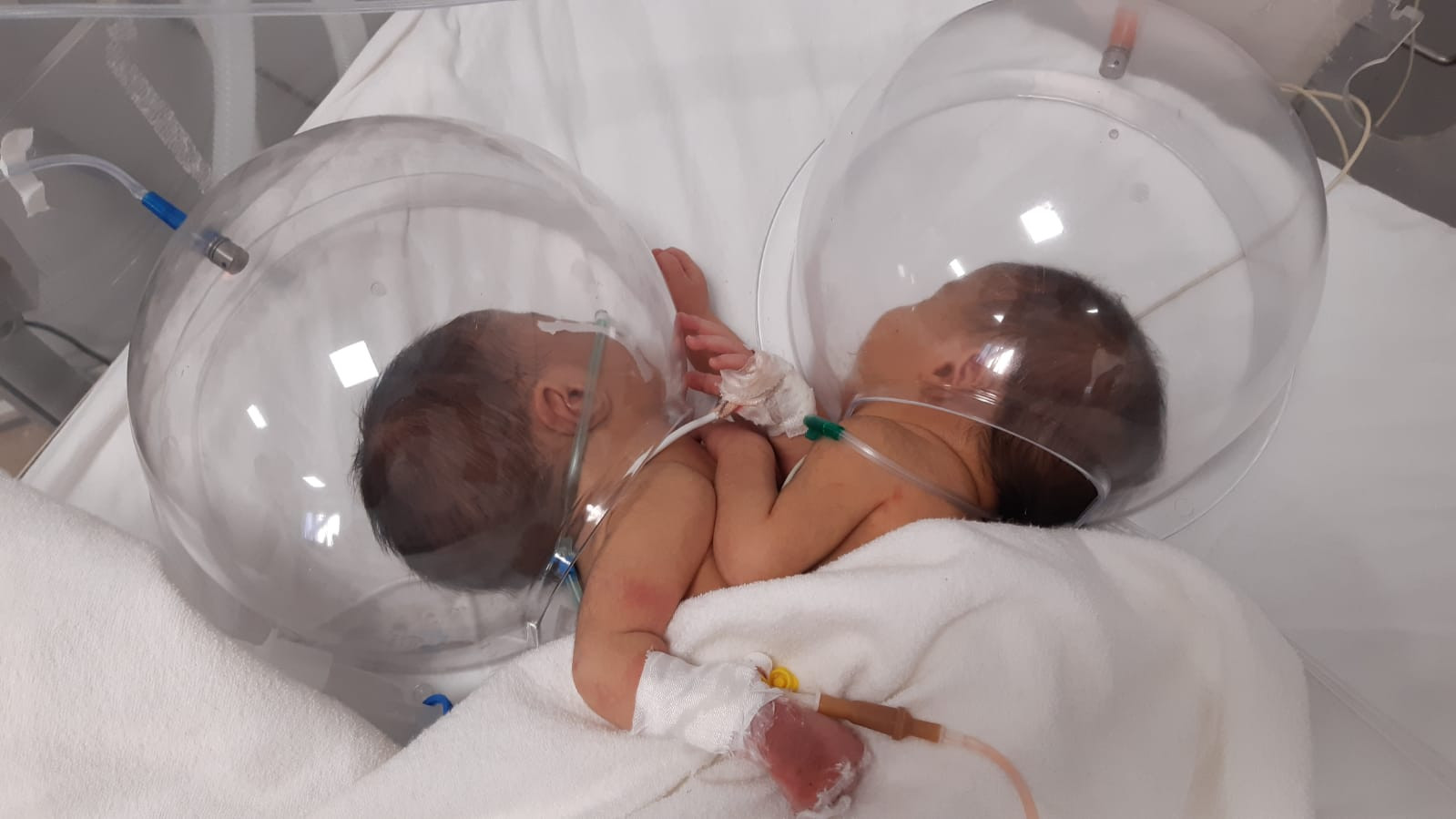 Conjoined twins need your help!