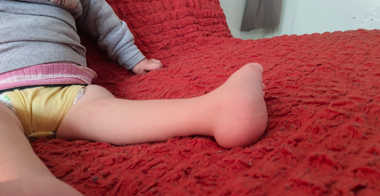 علي بحاجة مساعدتكم لتصحيح تشوه القدمين..