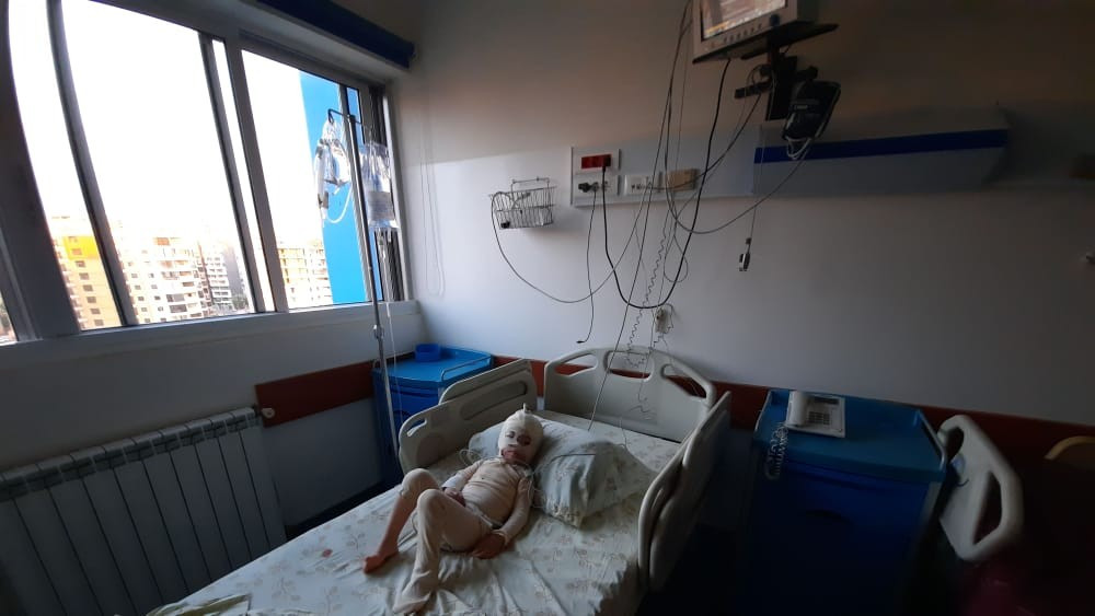 A little girl had a burn accident by boiled oil