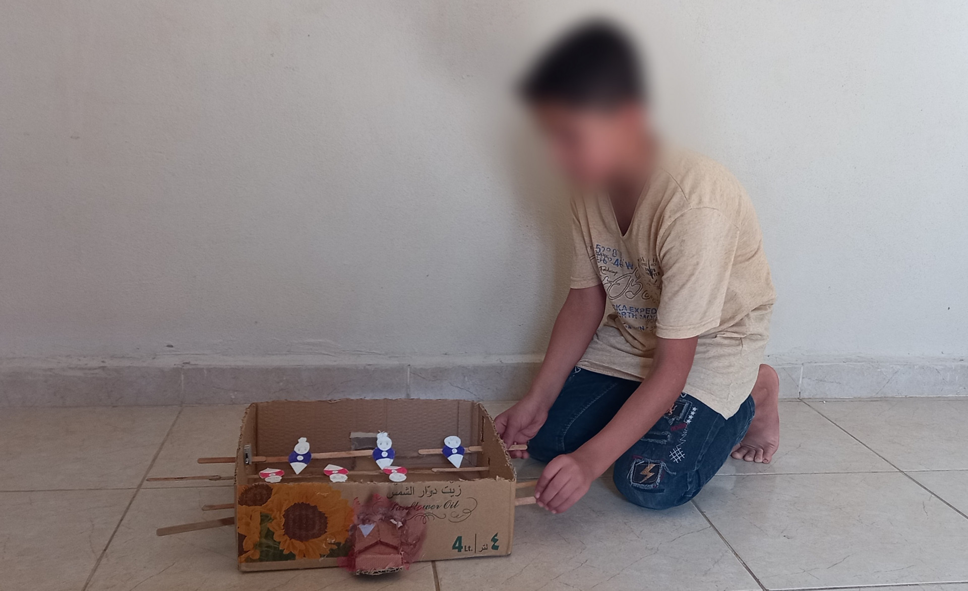 A displaced child lost his eye and needs an artificial eye