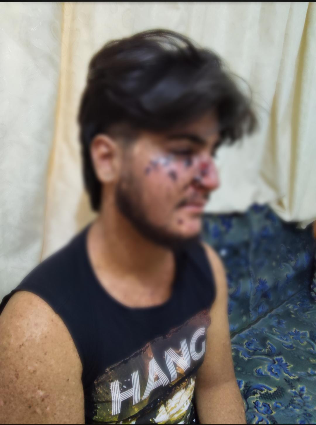 أمل محمود بحياة طبيعية يبدأ بعلاج وجهه