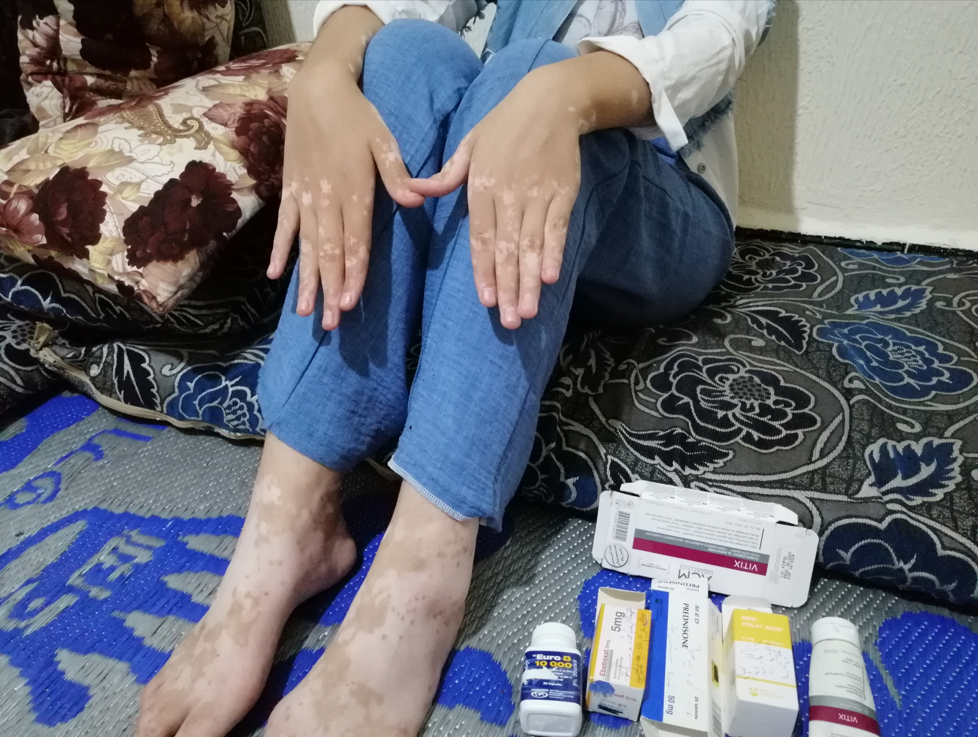 Ein Kind leidet an Vitiligo und braucht Behandlung
