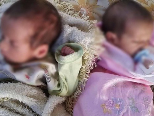 treatment expenses for little twins
