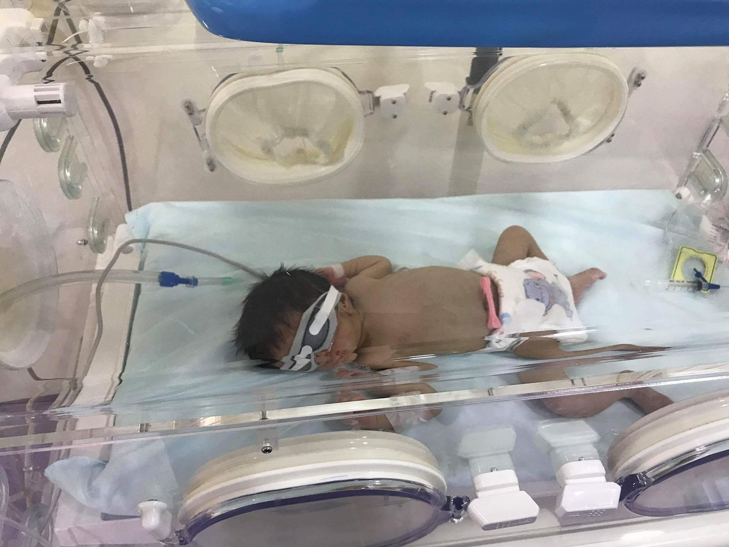 A Baby with Heart Problems Has Urgently to be Sent to the Incubator