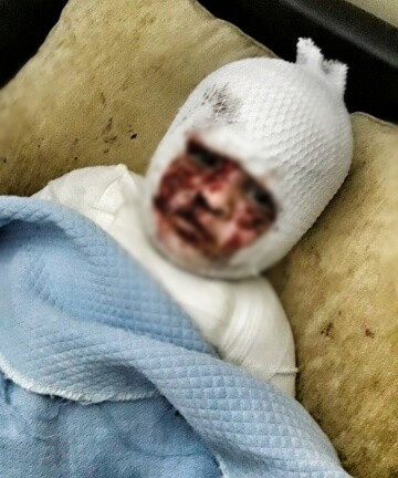 A beautiful girl suffered burns