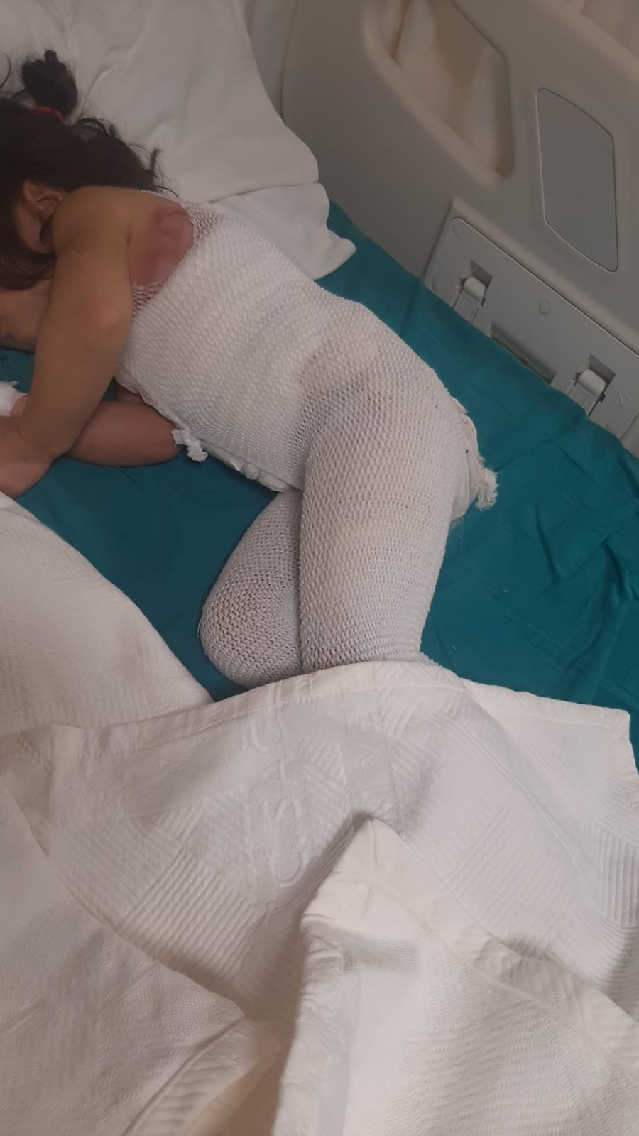 Burns in her feet and a lost childhood. Nermin is waiting for your donations.