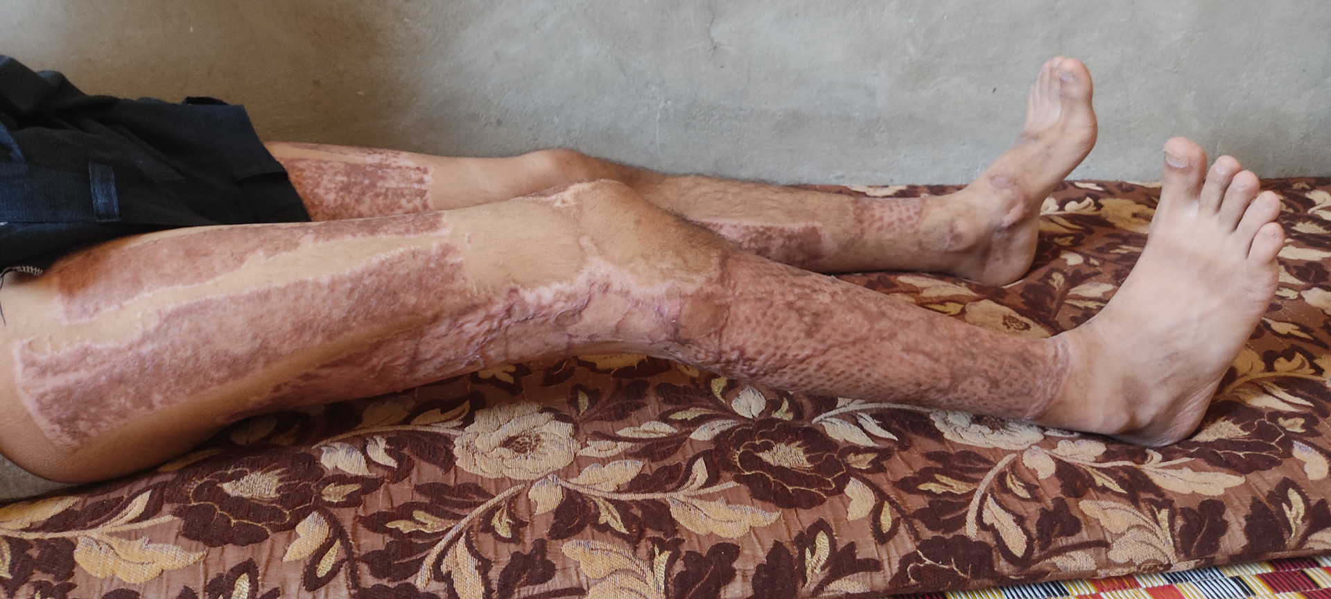 He suffers from severe burns!