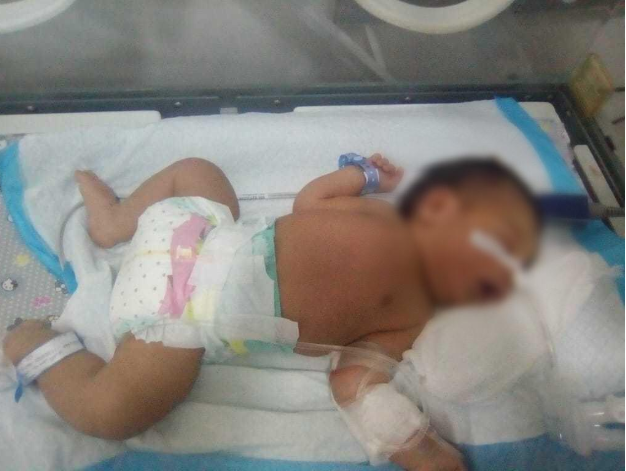 A neonate needs ventilator