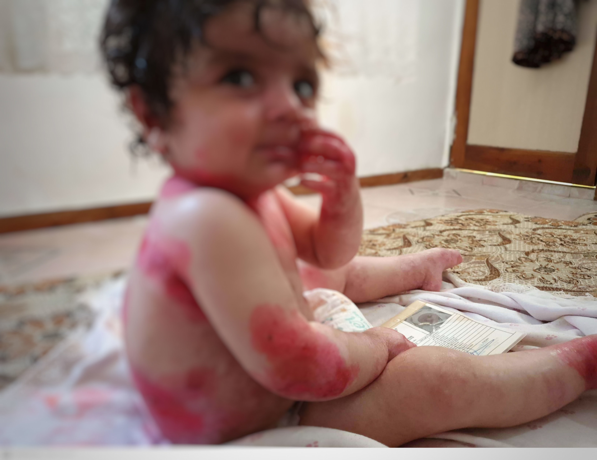 A baby girl suffers from extended burning areas due to a disease