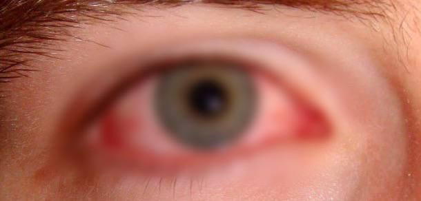 أختنا أميرة تنتظر دعمكم لتنقذ بصرها