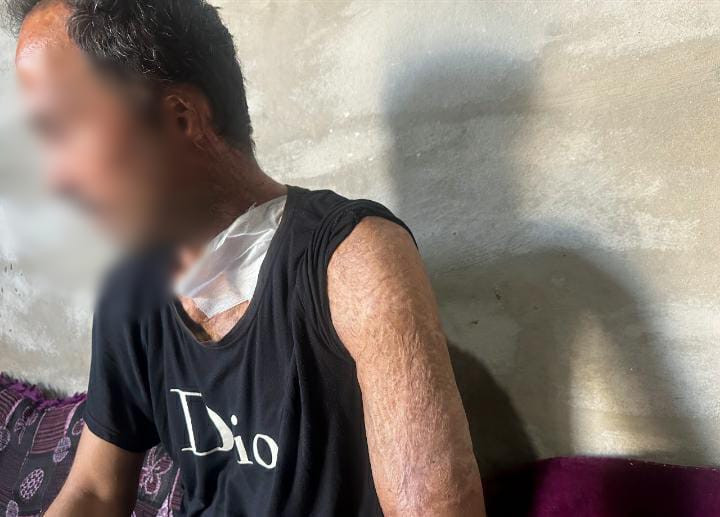 Mr. Hussein was disfigured by a fire