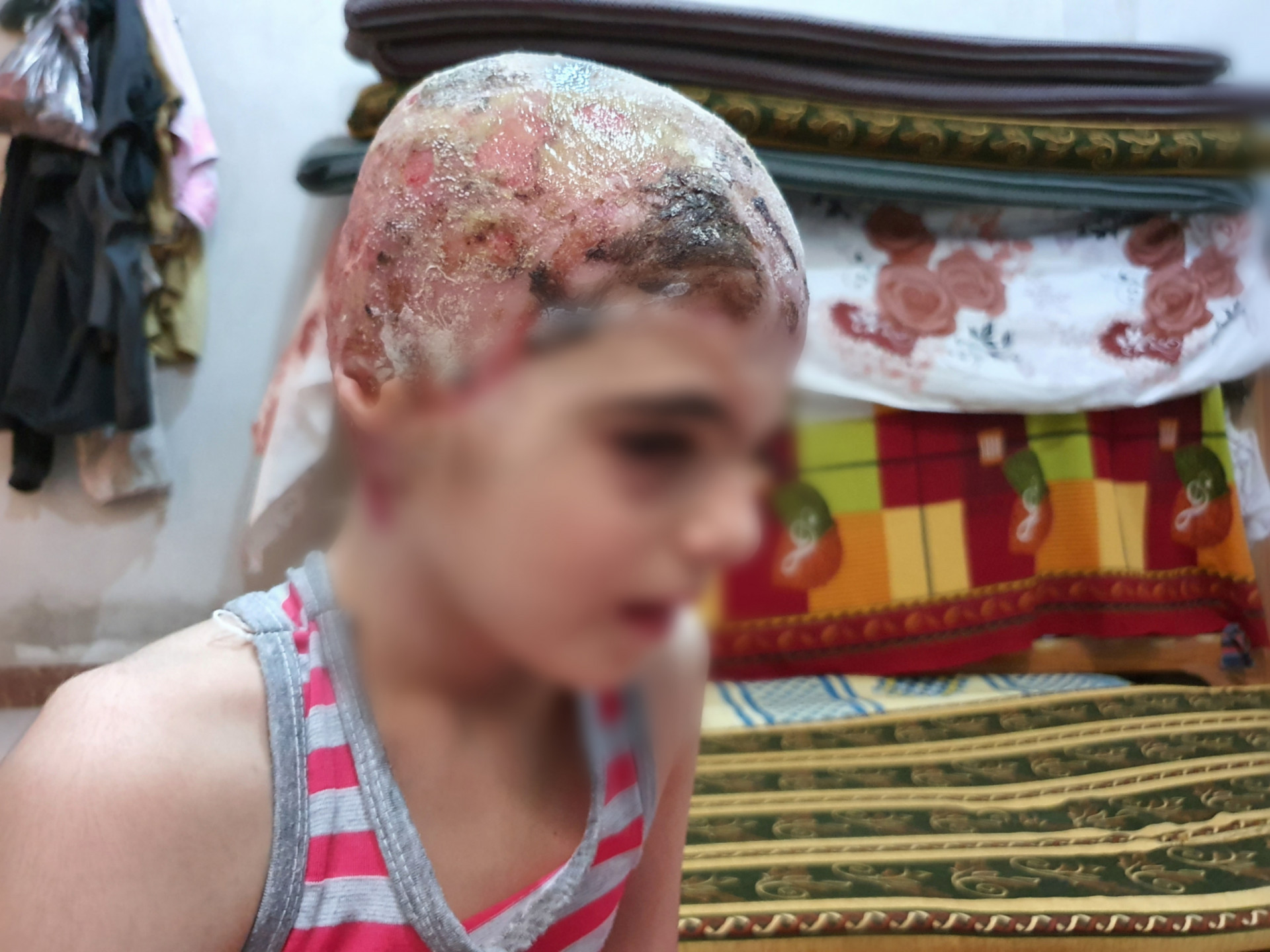 A horrible accident cost Fatima her hair and her scalp. Fatima needs your urgent help.
