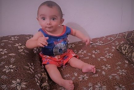 Developmental dysplasia of the hip