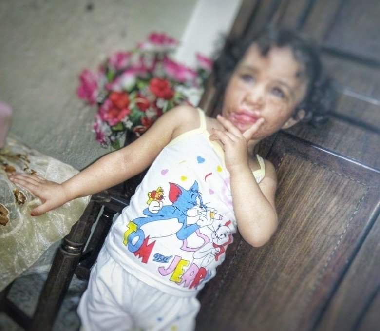 A girl child with severe burns