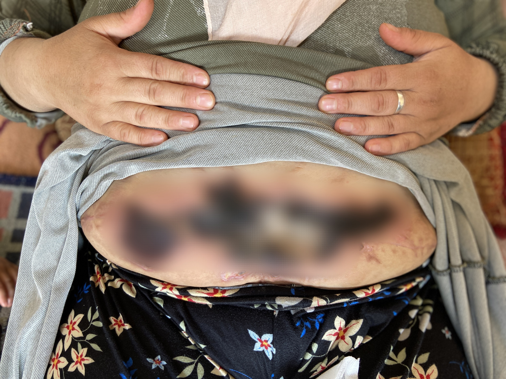 Amani's pain increases day by day, yet she is unable to afford the treatment she desperately needs.
