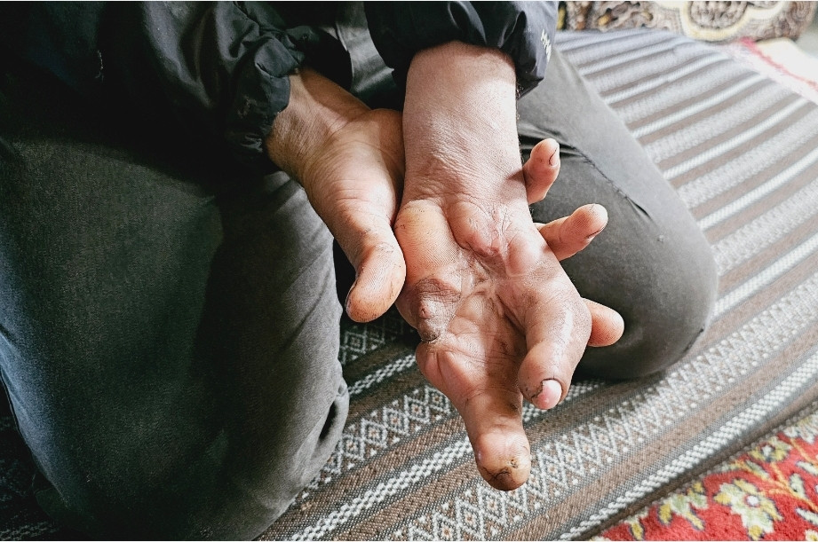 A cluster bomb attack led to the amputation of Ibrahim's fingers .