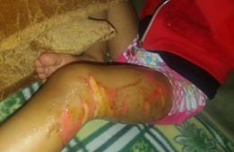 A kid suffering from burns