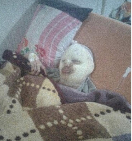he suffers from brain atrophy in addition to head and face burns .... he needs medications and transportation cost..