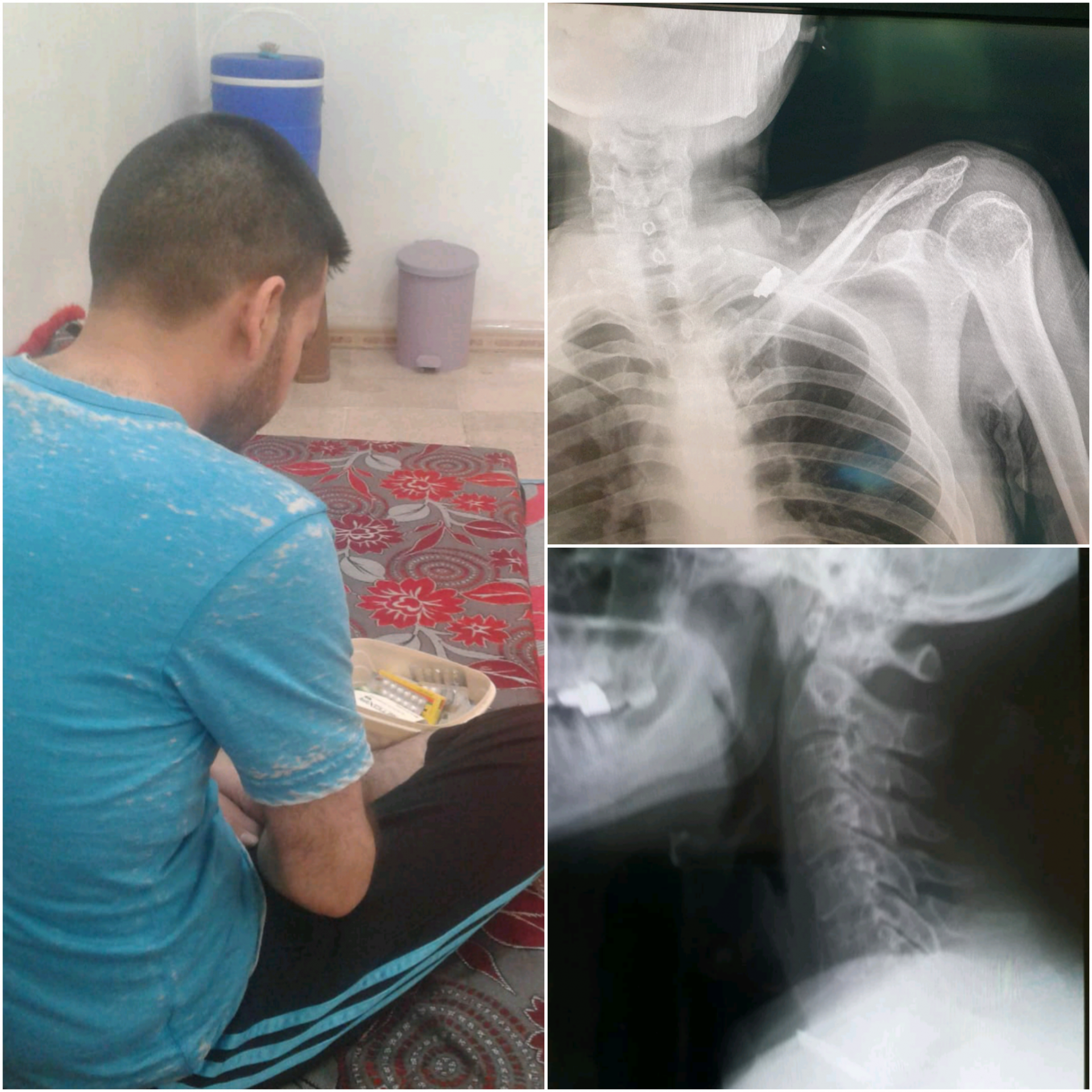 A young man suffers from back injury