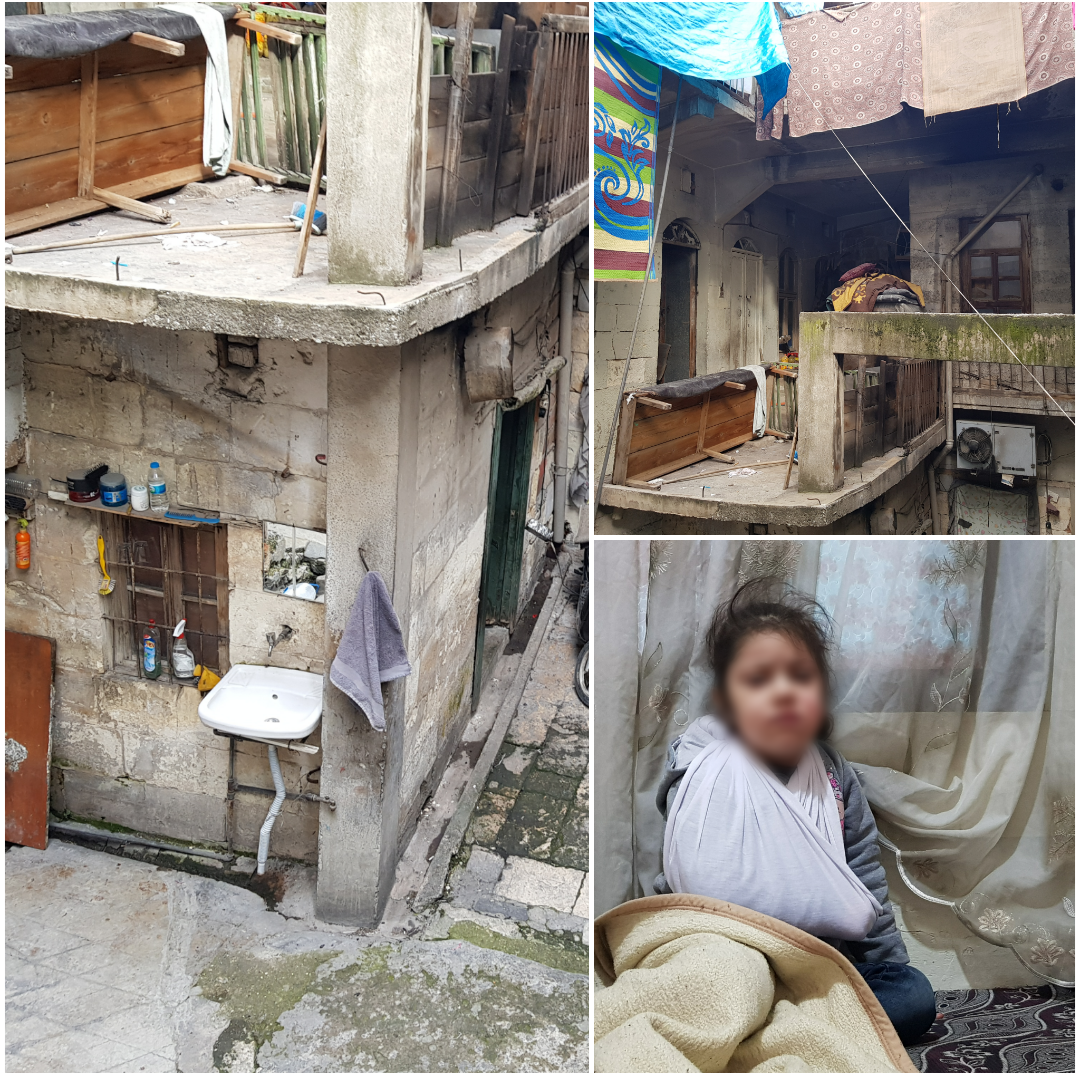 A girl child with a broken shoulder