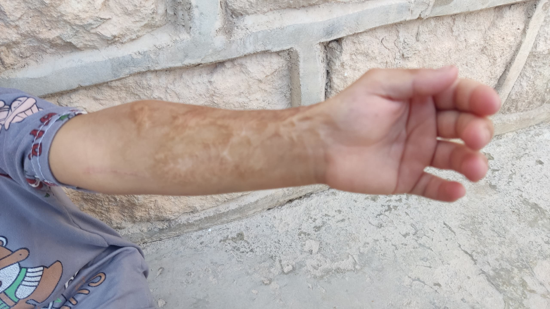 بقي أثرُ الحريق في يدها