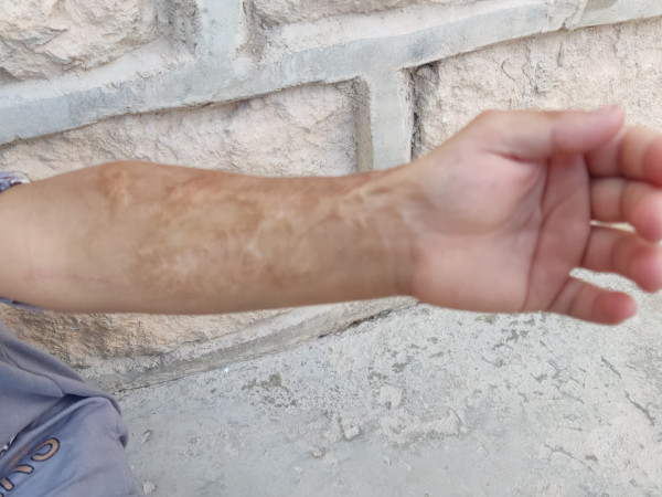 بقي أثرُ الحريق في يدها