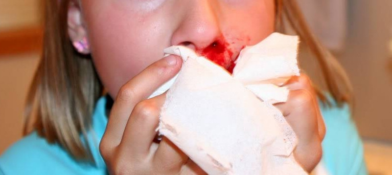 She fell and broke her nose, now requiring surgical intervention.