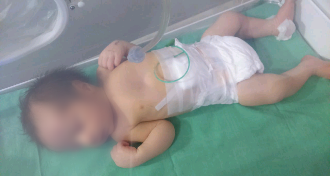 A newborn with meningitis