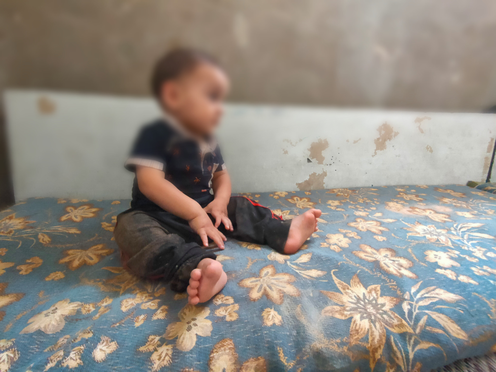 Baby Ahmed has a bilateral urethra and needs urgent surgery.
