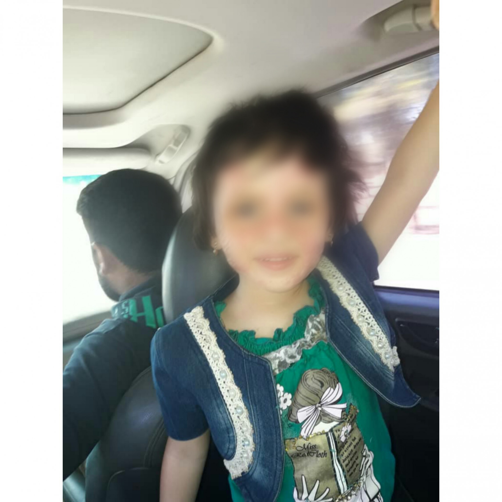 طفلة تعاني من تشوه في الوجه بسبب الحروق