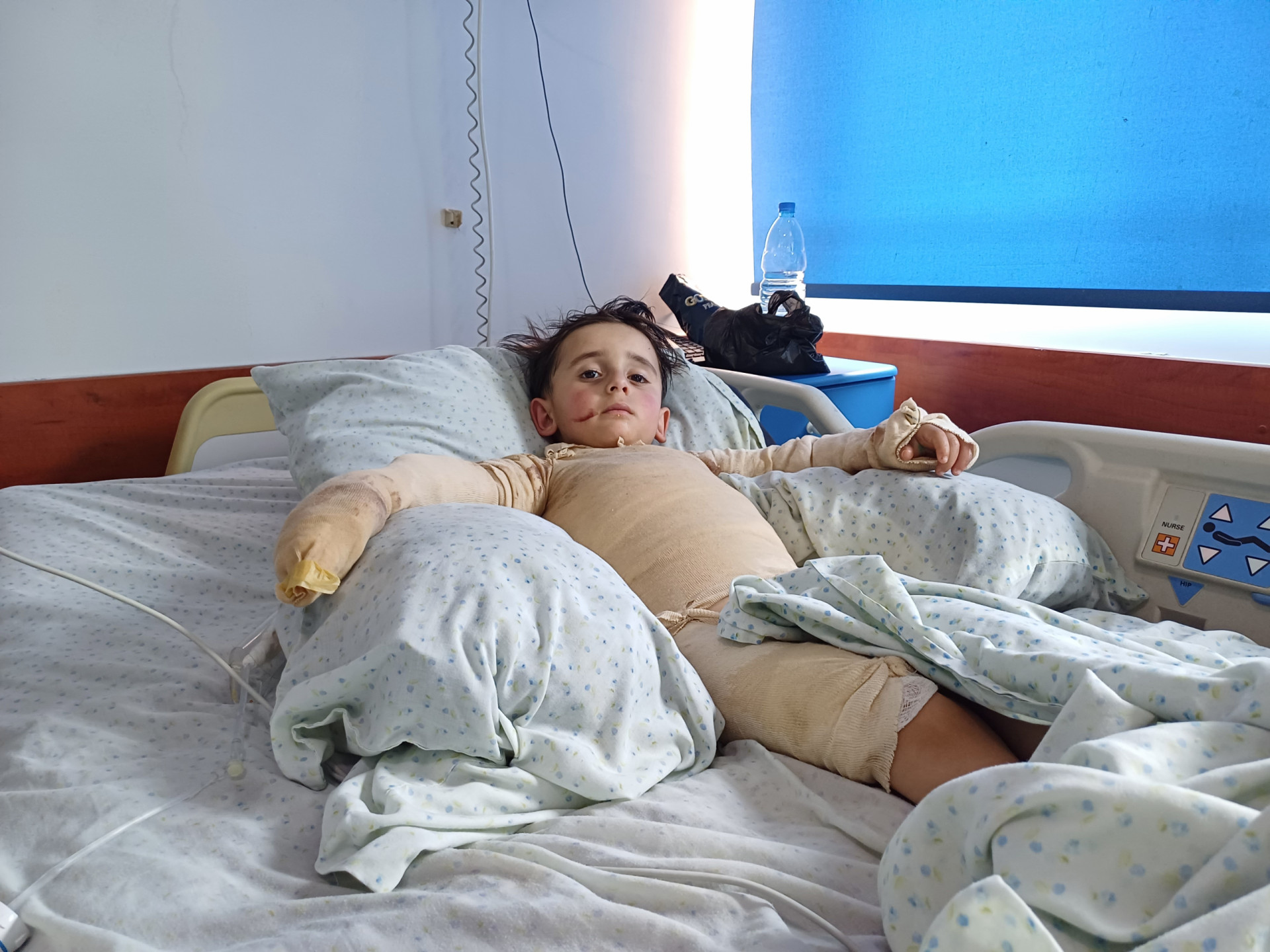 A child whose body was burned and needs urgent treatment!