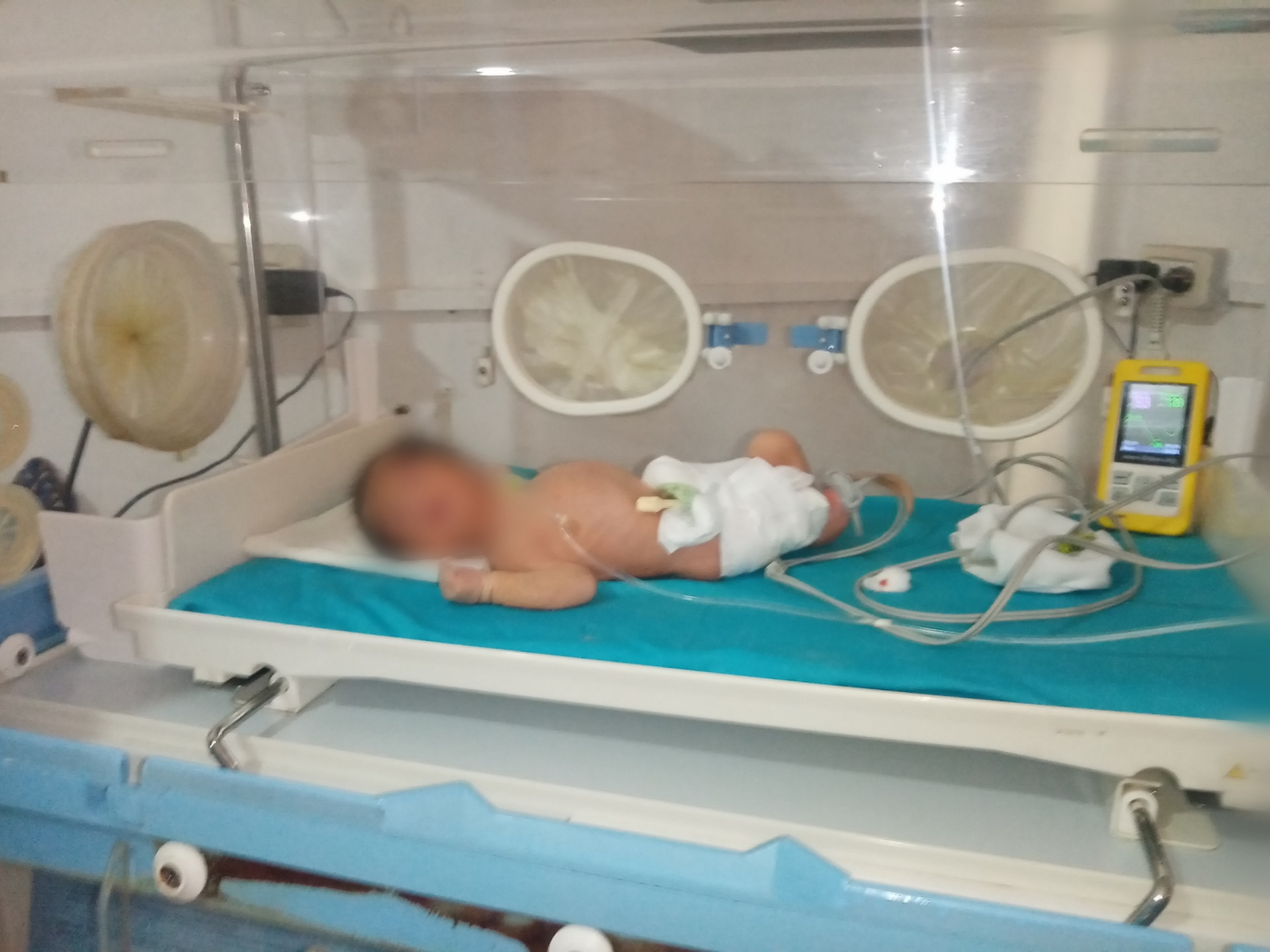 Joad needs to stay in the NICU to live