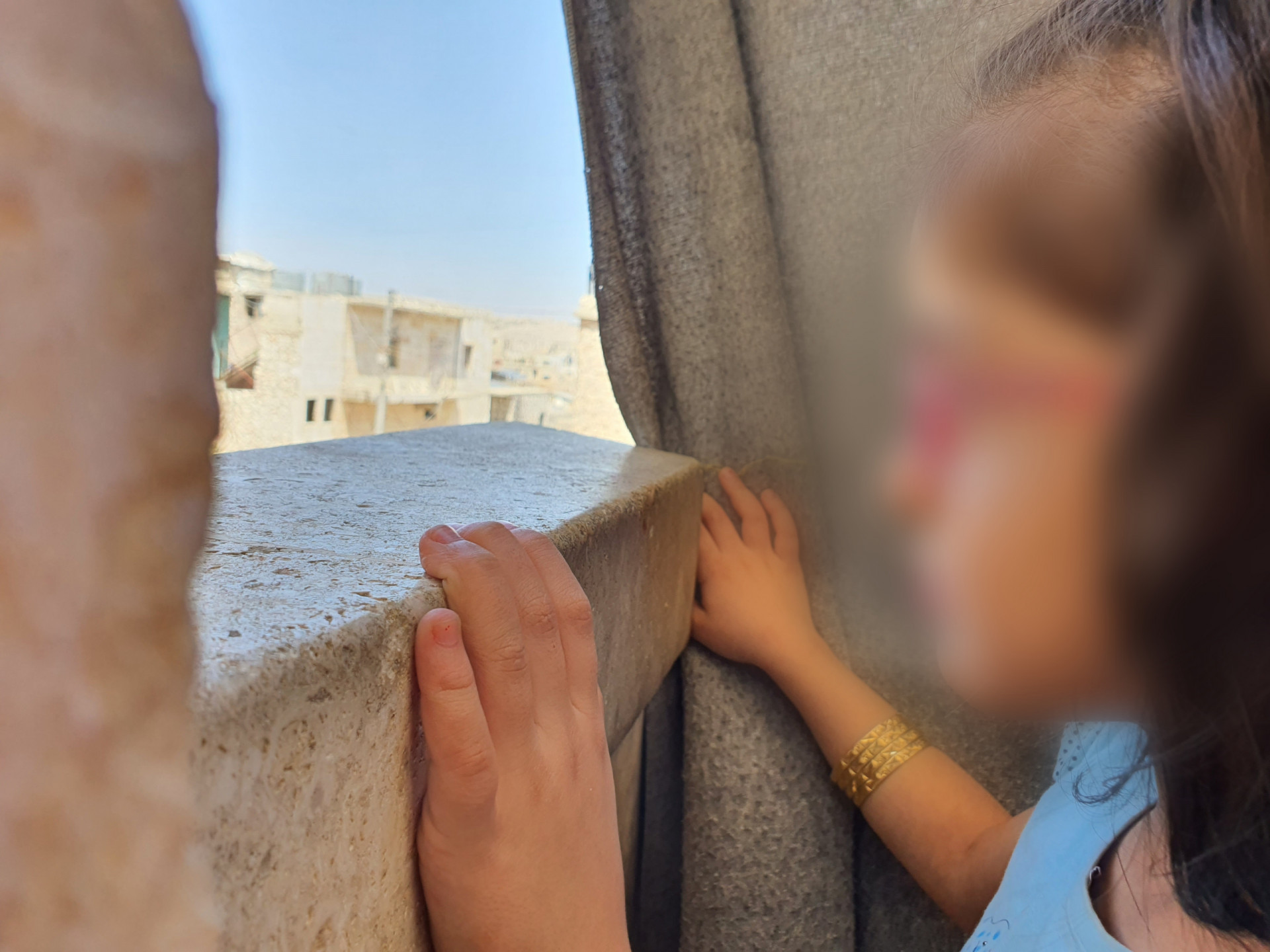 A girl suffering from strabismus needs urgent surgery
