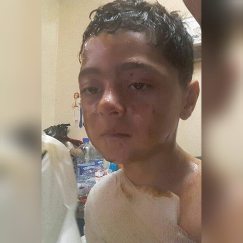 A refugee with face and chest burns