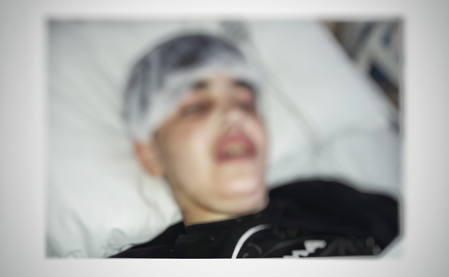 A child with Crohn disease