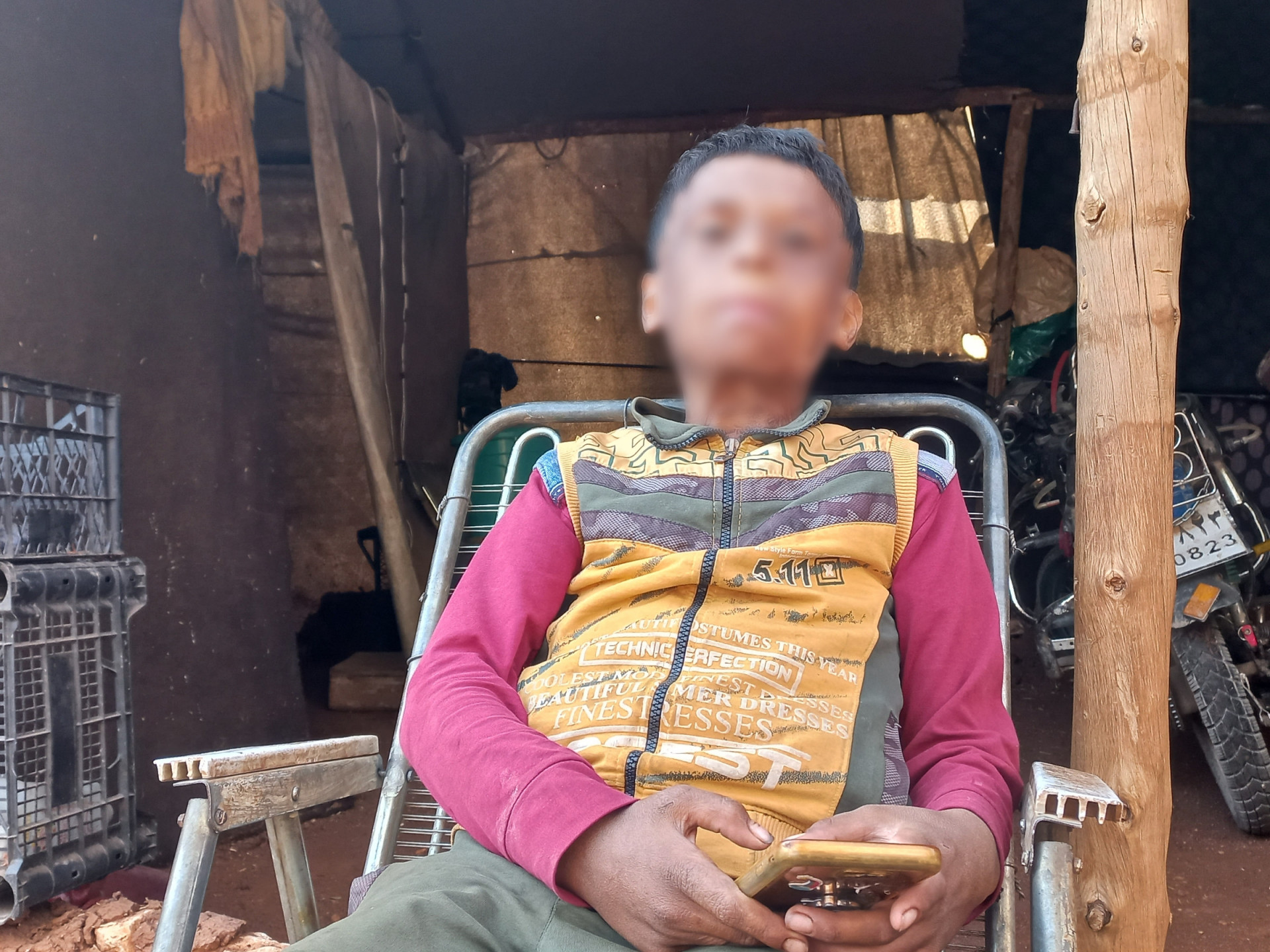 A tent caught on fire caused face burns that destroyed this child's life.