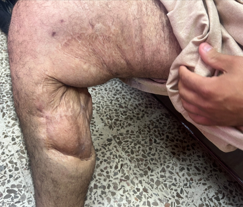 يوسف… حادث واحد غيّر كل حياته