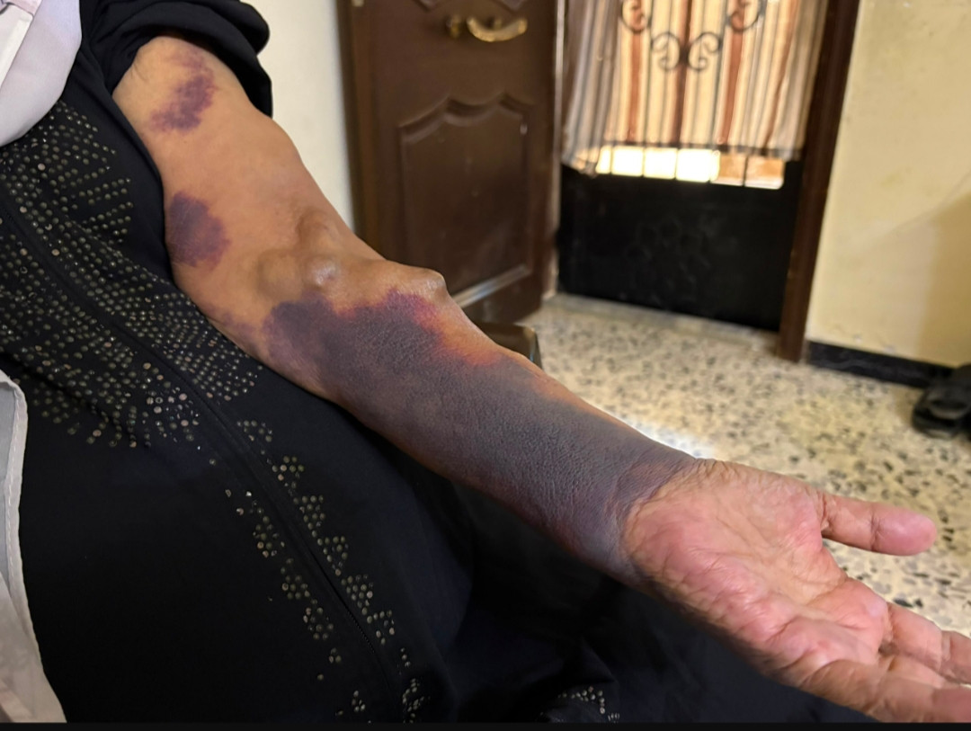 خديجة بين غسيل الكلى ومضاعفات المرض