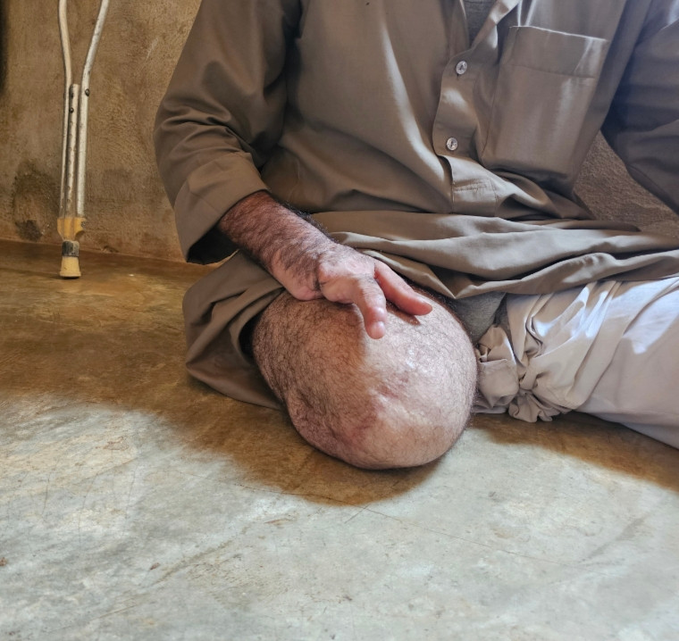 الإصابة تعجزه عن إعالة أطفاله