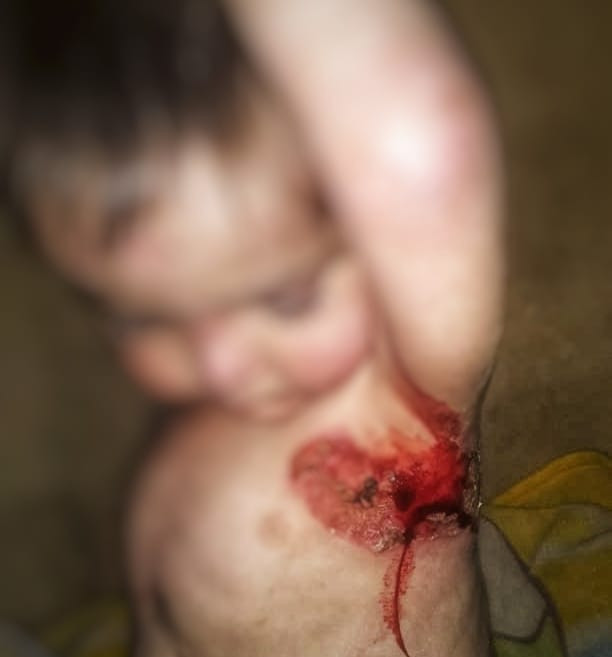 Sulaiman, a child with brain atrophy and pemphigus