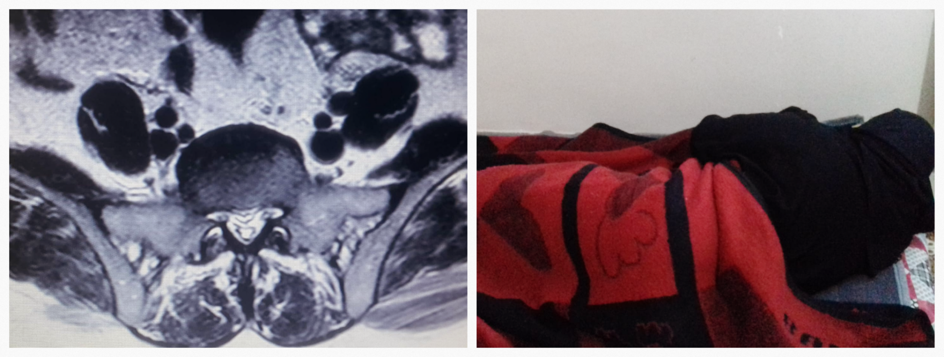 A woman with herniated desk is bedridden