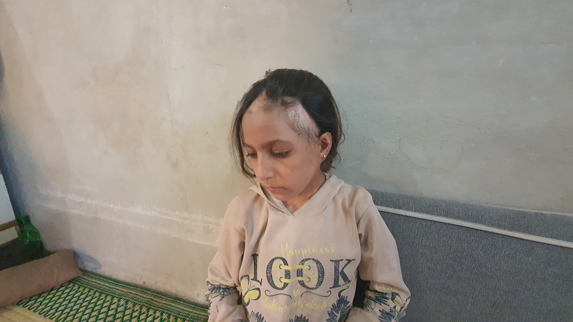Burn injuries in her head caused her psychological state to deteriorate and ruined her childhood