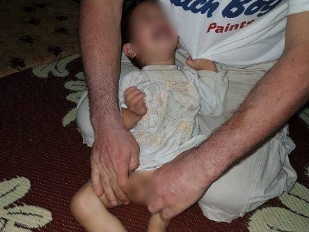 Urgent surgery for a baby